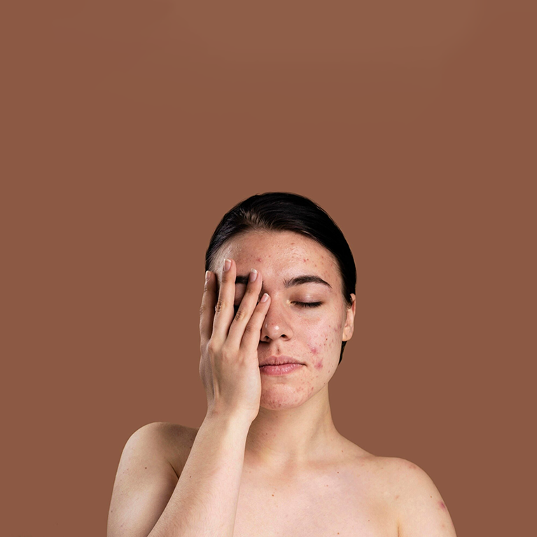 Pregnancy and Skin Issues: How Hormonal Imbalance Affects Your Skin