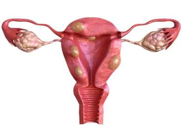 Top fibroids and fertility clinic in Nungambakkam Chennai
