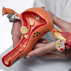 myomectomy treatment for fibroids in Chennai, Kodambakkam