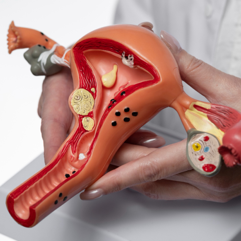 Myomectomy: Procedure, Benefits, Risks & Recovery Guide