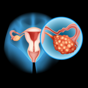 Silent signs of fibroids that women often ignore