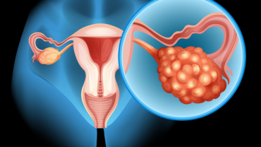 Silent signs of fibroids that women often ignore