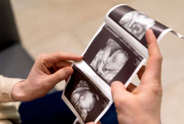 20 week anomaly scan ultrasound images showing fetal development