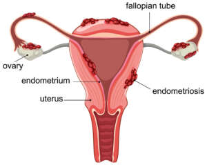 Best treatment for uterine fibroids in Chennai uterus fibroid medical diagram