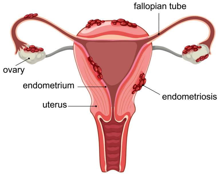 Best Treatment for Uterine Fibroids in Chennai | The Birthwave Clinic
